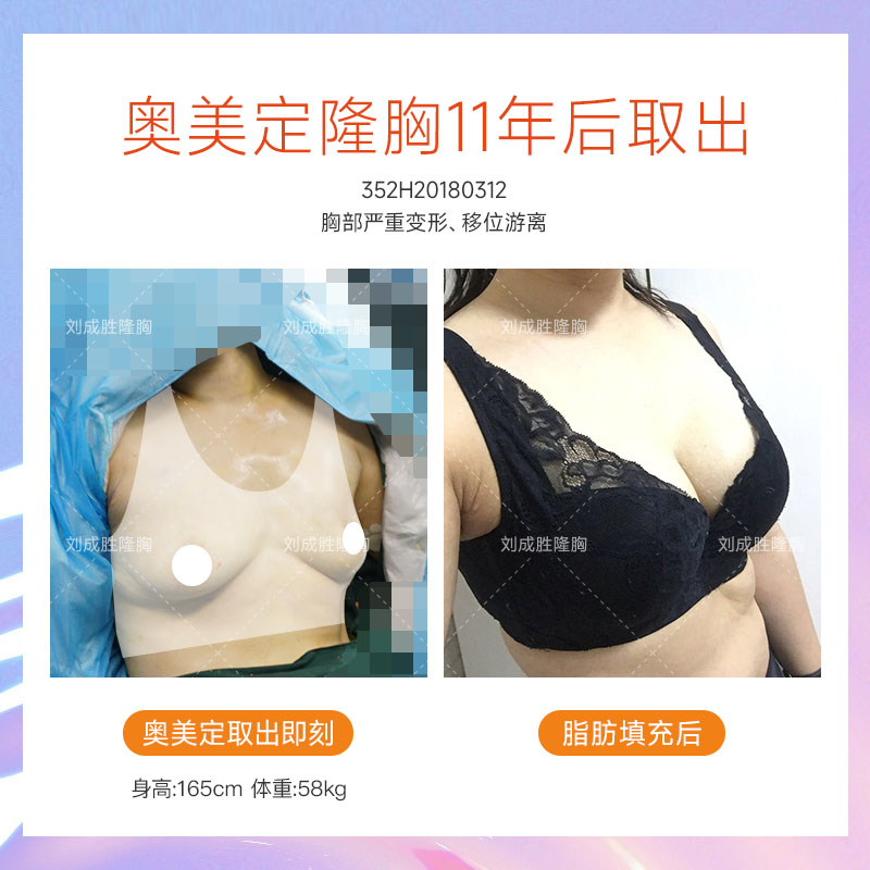 丰体针丰胸潜在危害，你必须知道的关键风险